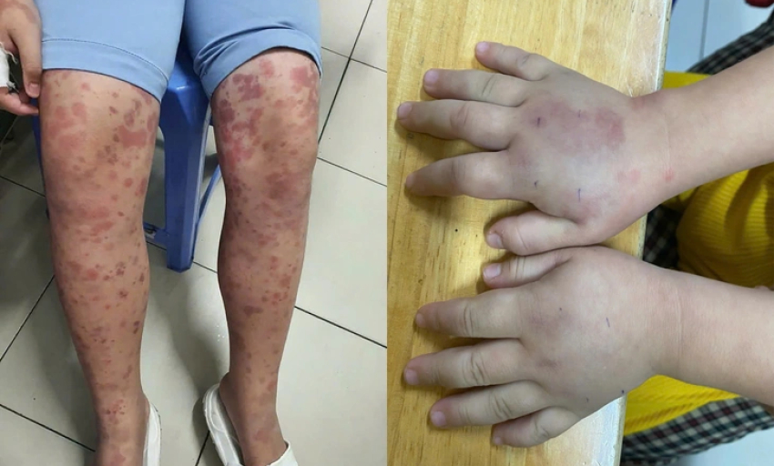 Cảnh báo bệnh ban xuất huyết Schonlein - Henoch gây biến chứng thận nguy hiểm ở trẻ em