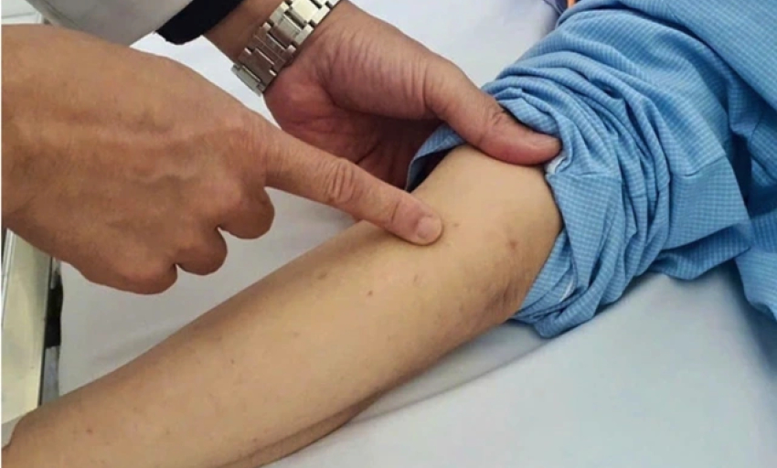 Viêm não mô cầu: Dấu hiệu cảnh báo cần cấp cứu ngay