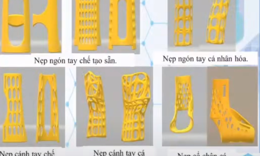 Nẹp chấn thương chỉnh hình bằng công nghệ in 3D