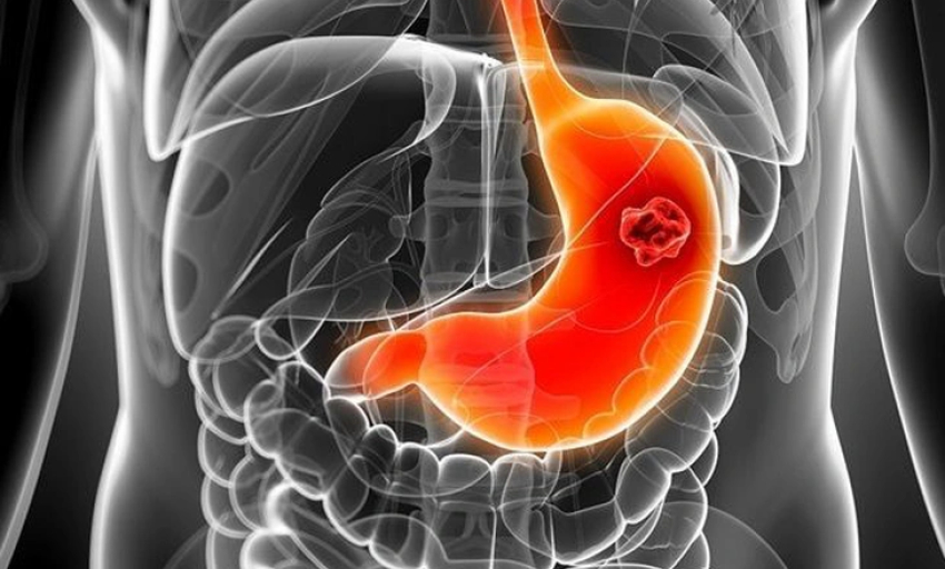 Cách trị viêm loét dạ dày - tá tràng qua bữa ăn