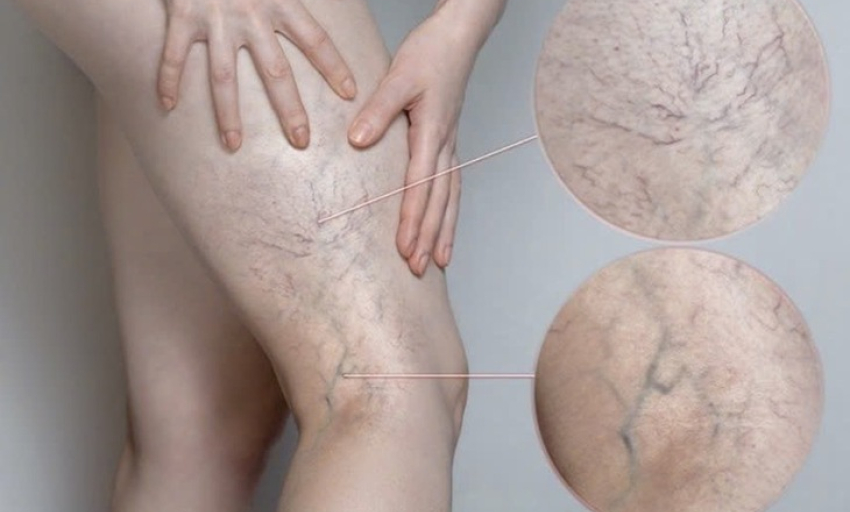Chân đau nhức, mạch máu lộ rõ cảnh báo bệnh lý đang đe dọa 1/3 người trưởng thành
