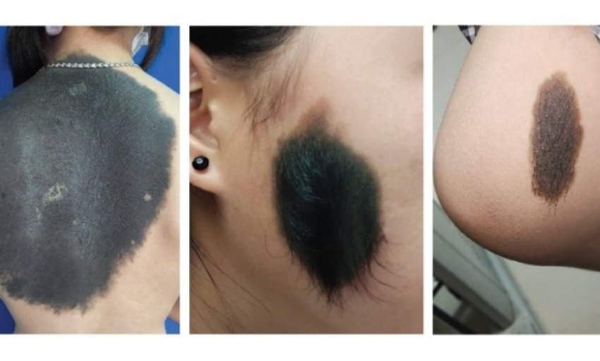 Nơ vi hắc tố bẩm sinh không đơn thuần là “vết bớt” vô hại