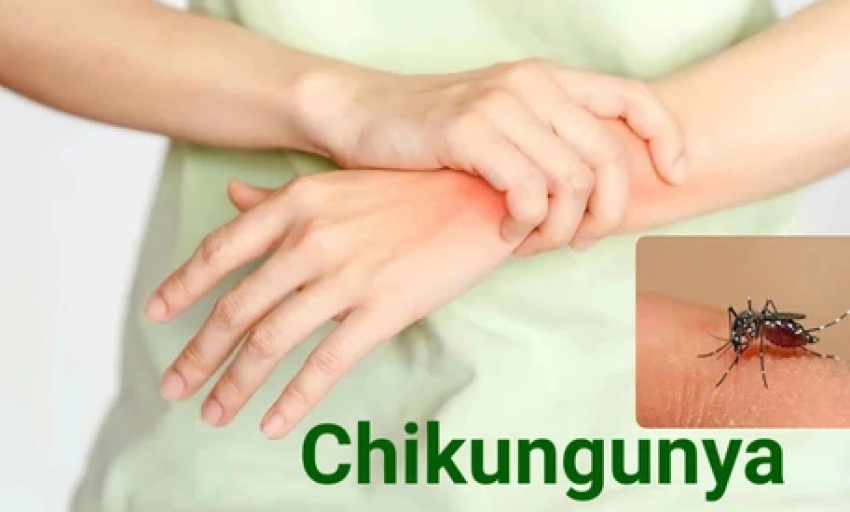 Bộ Y tế bác thông tin Việt Nam phát hiện ca mắc Chikungunya