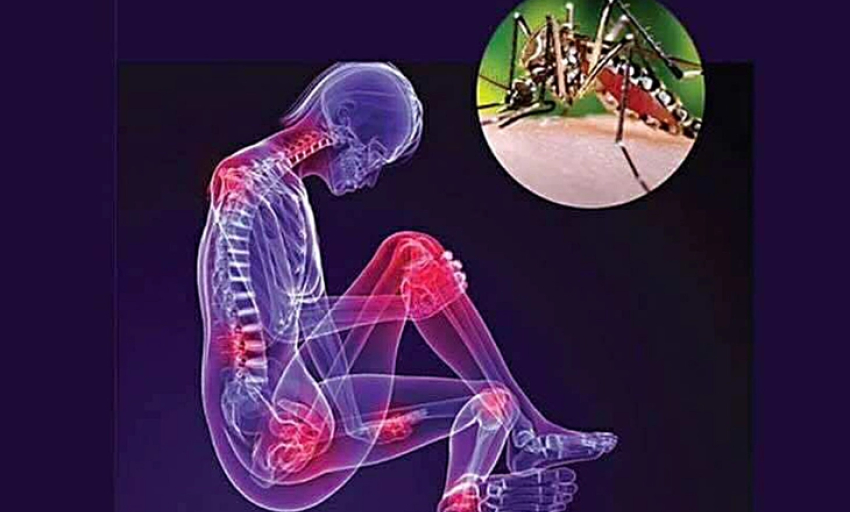 Dấu hiệu nhận biết bệnh Chikungunya và cách phòng bệnh