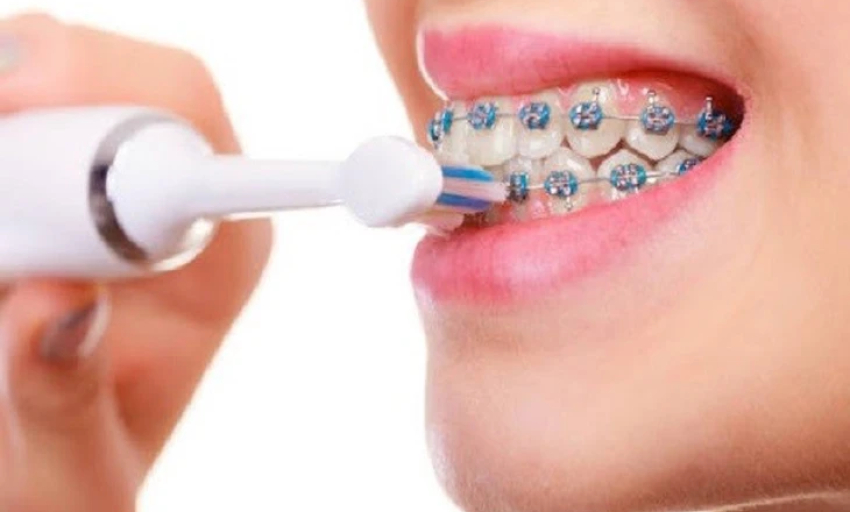 Hai lợi ích ít được biết đến của việc niềng răng