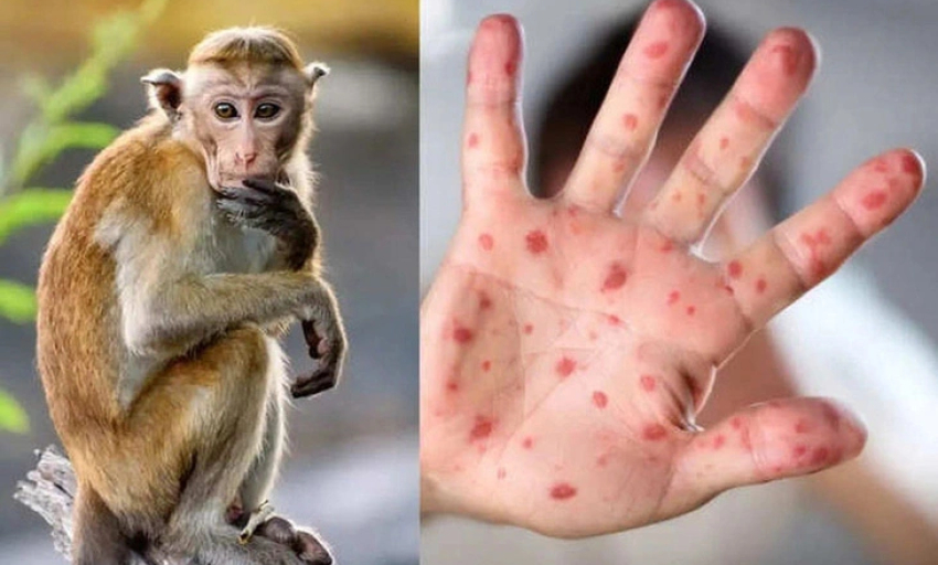 Bệnh đậu mùa khỉ gần giống bệnh thủy đậu, cần phân biệt thế nào?