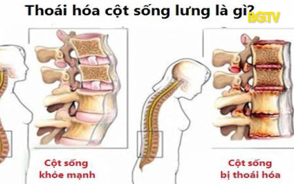 Những điều cần biết về bệnh thoái hóa cột sống thắt lưng 