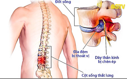 PBKT: Chăm sóc phục hồi cho người thoát vị đĩa đệm